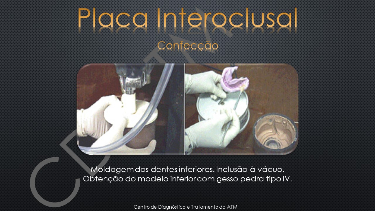 PLACA INTEROCLUSAL 06